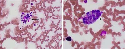 Case Report: A unique case of secondary hemophagocytic lymphohistiocytosis from ehrlichiosis infection
